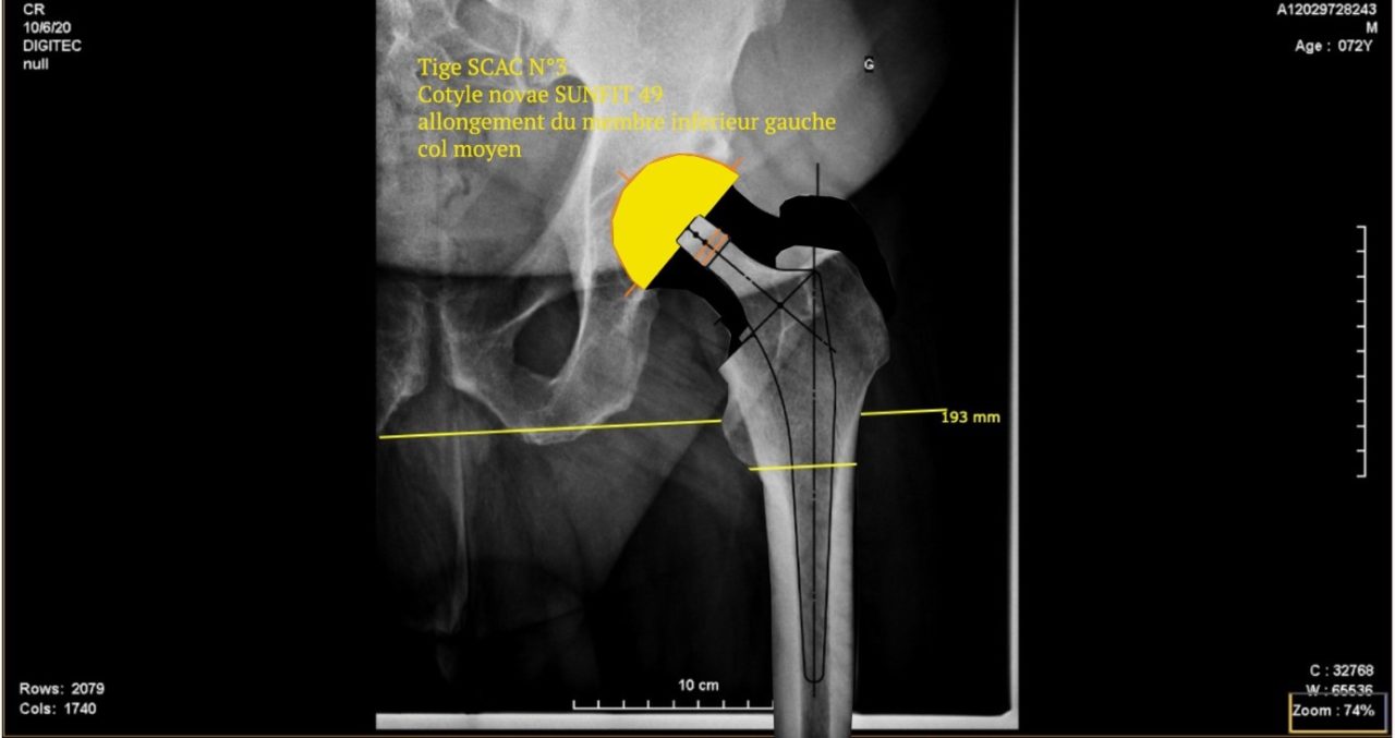 Prothese totale de hanche gauche 1